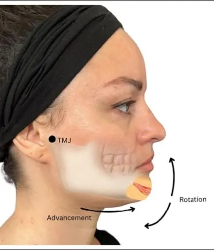 Chin Augmentation and the advancement-rotation principle