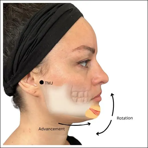 Chin Augmentation and the advancement-rotation principle